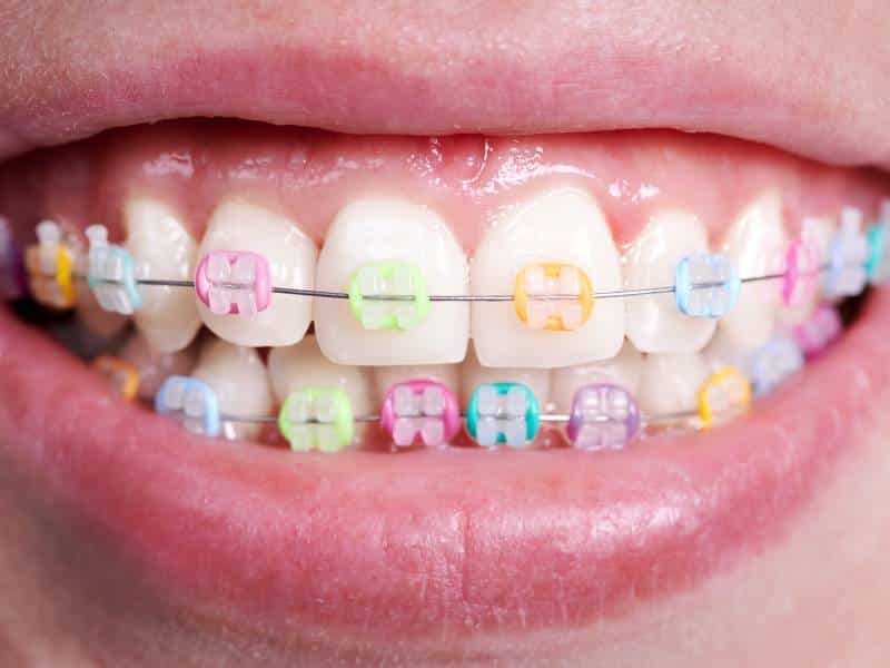 A child with colorful elastics on their ceramic braces in Salt Lake City, UT